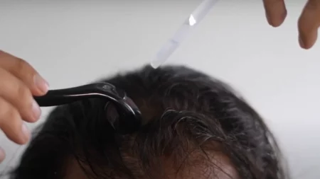 alopecia