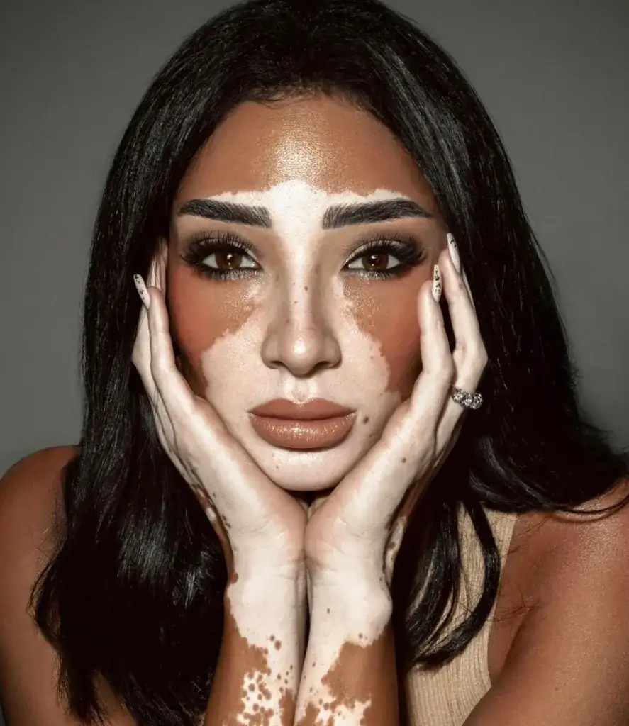 Logina Salah, la primera modelo con vitiligo en Miss Universe 2024: le contamos su historia 1 Logain-Salah-photo-1