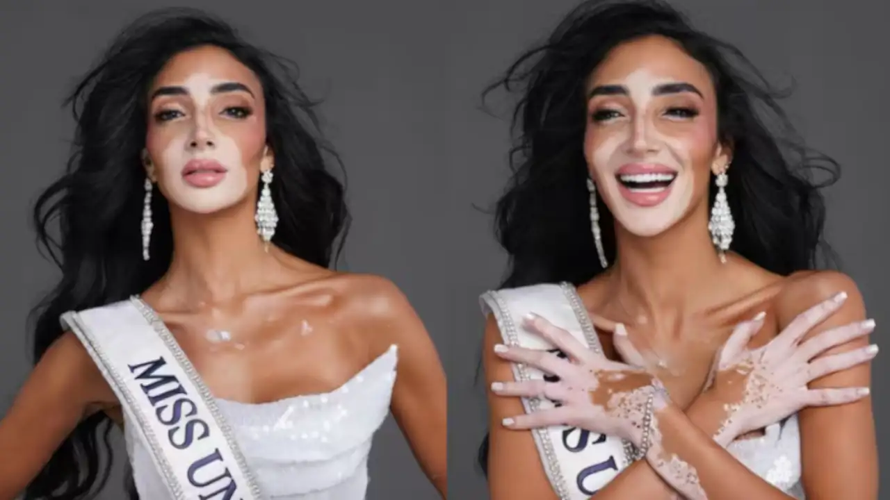 Miss-Universe-vitiligo