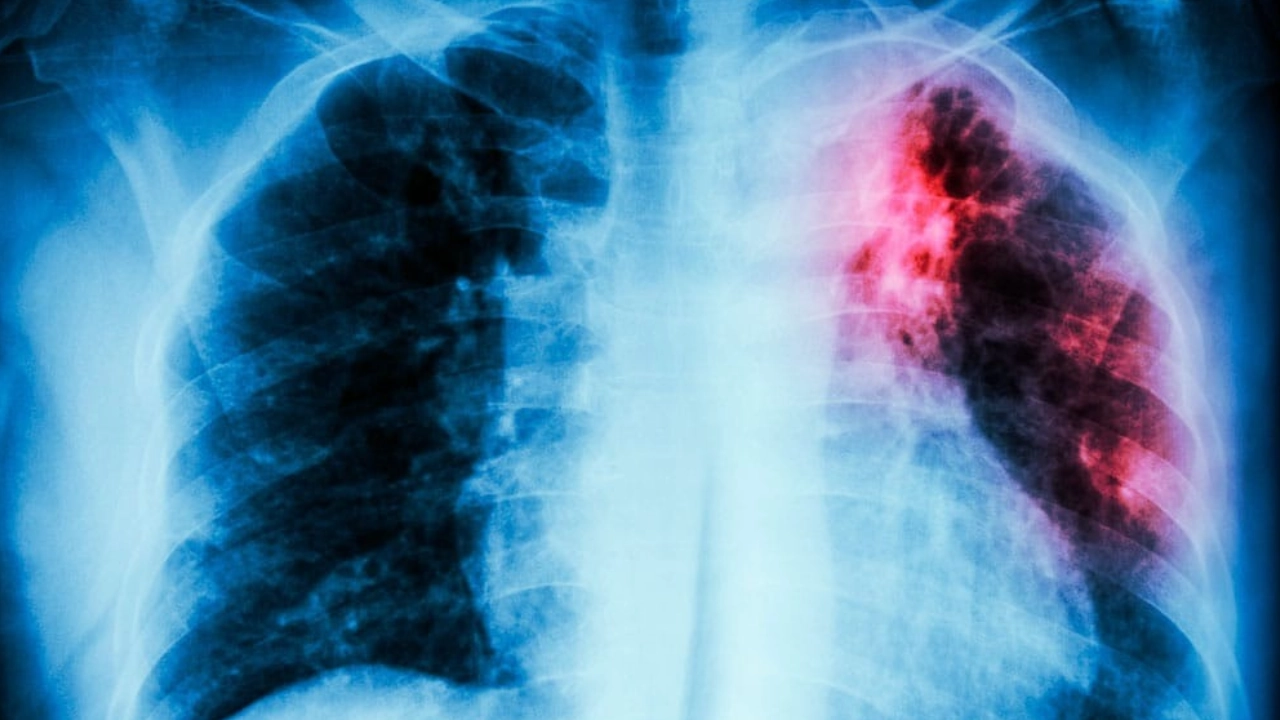 tuberculosis-salud-pulmones