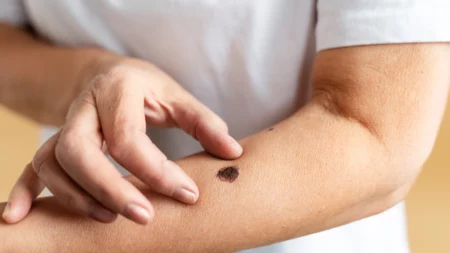 melanoma-1