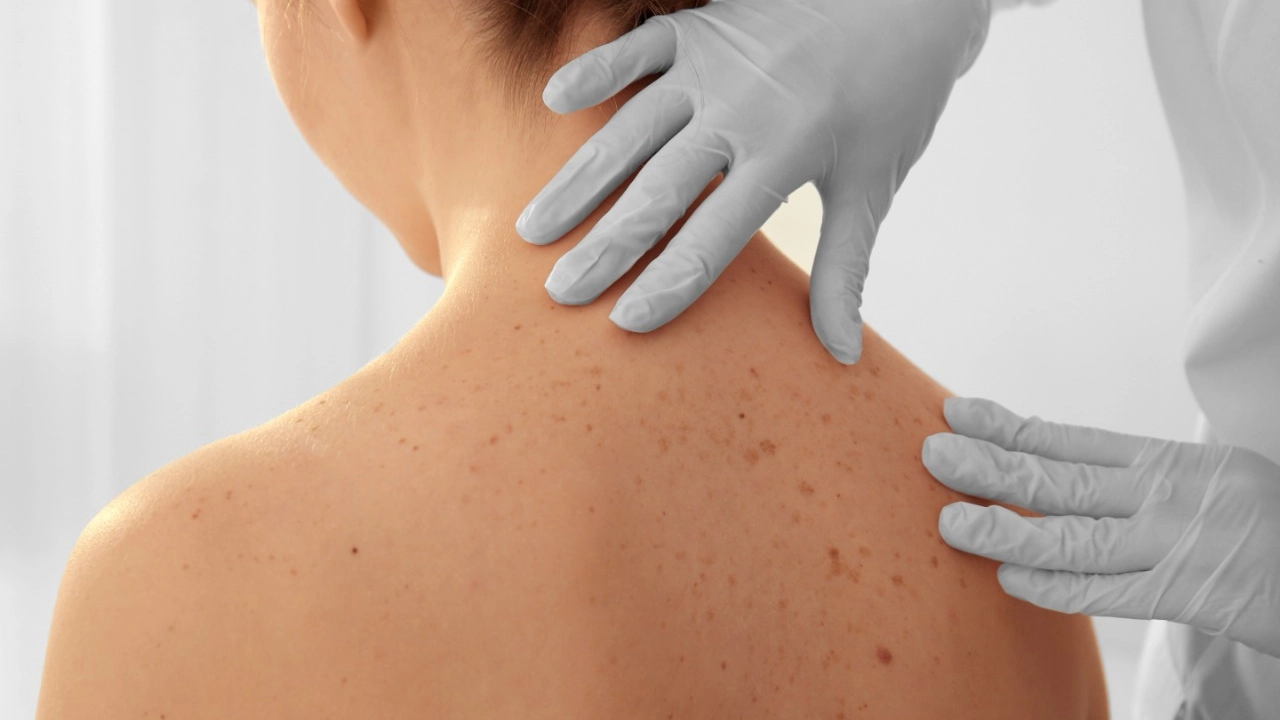Más que arte: tatuadores ayudan a detectar el cáncer de piel a tiempo 1 melanoma-2