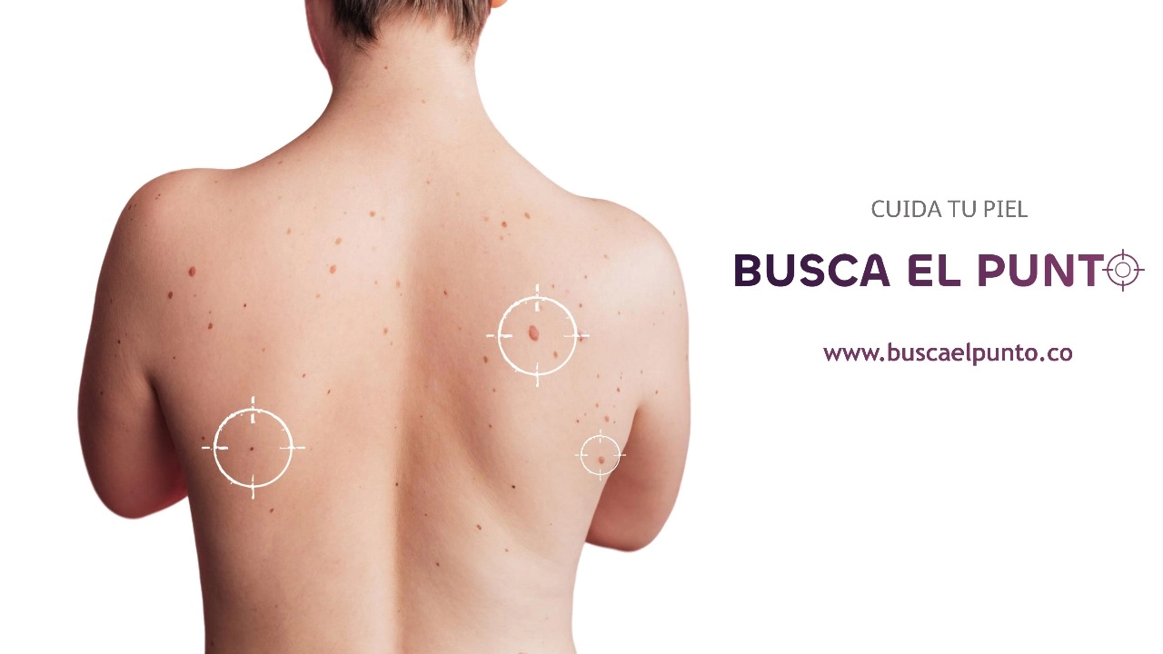 Más que arte: tatuadores ayudan a detectar el cáncer de piel a tiempo 2 melanoma-3